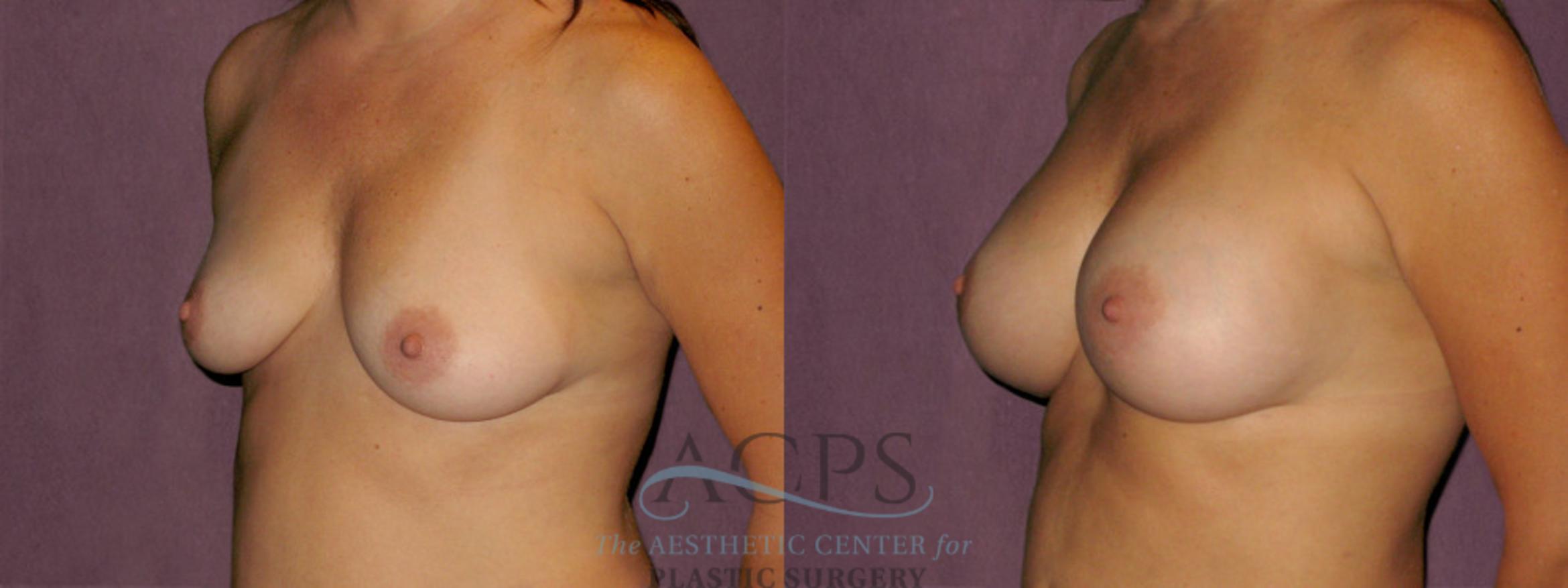 Before & After Breast Augmentation Case 933 Oblique Left View: View in Houston, TX