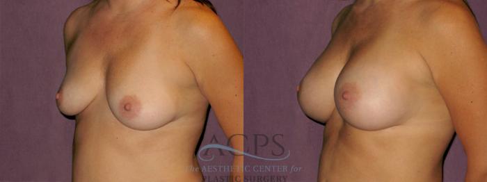 Before & After Breast Augmentation Case 933 Oblique Left View: View in Houston, TX