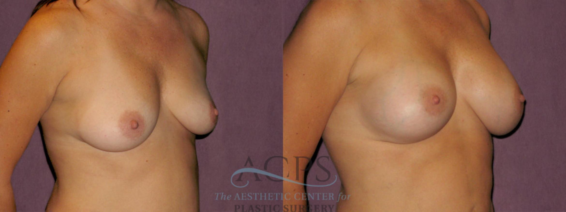 Before & After Breast Augmentation Case 933 Oblique Right View: View in Houston, TX