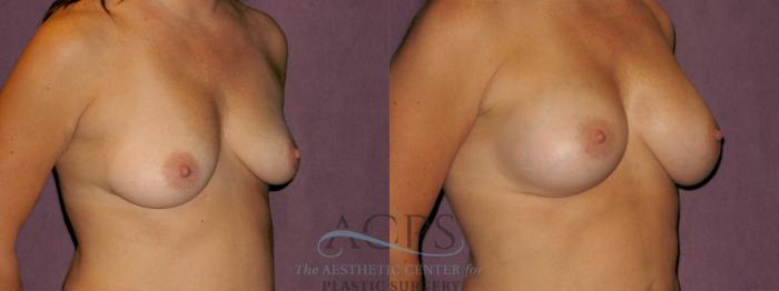 Before & After Breast Augmentation Case 933 Oblique Right View: View in Houston, TX