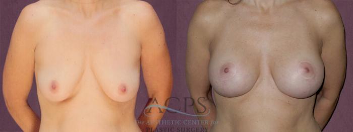Before & After Breast Augmentation Case 934 Front View: View in Houston, TX