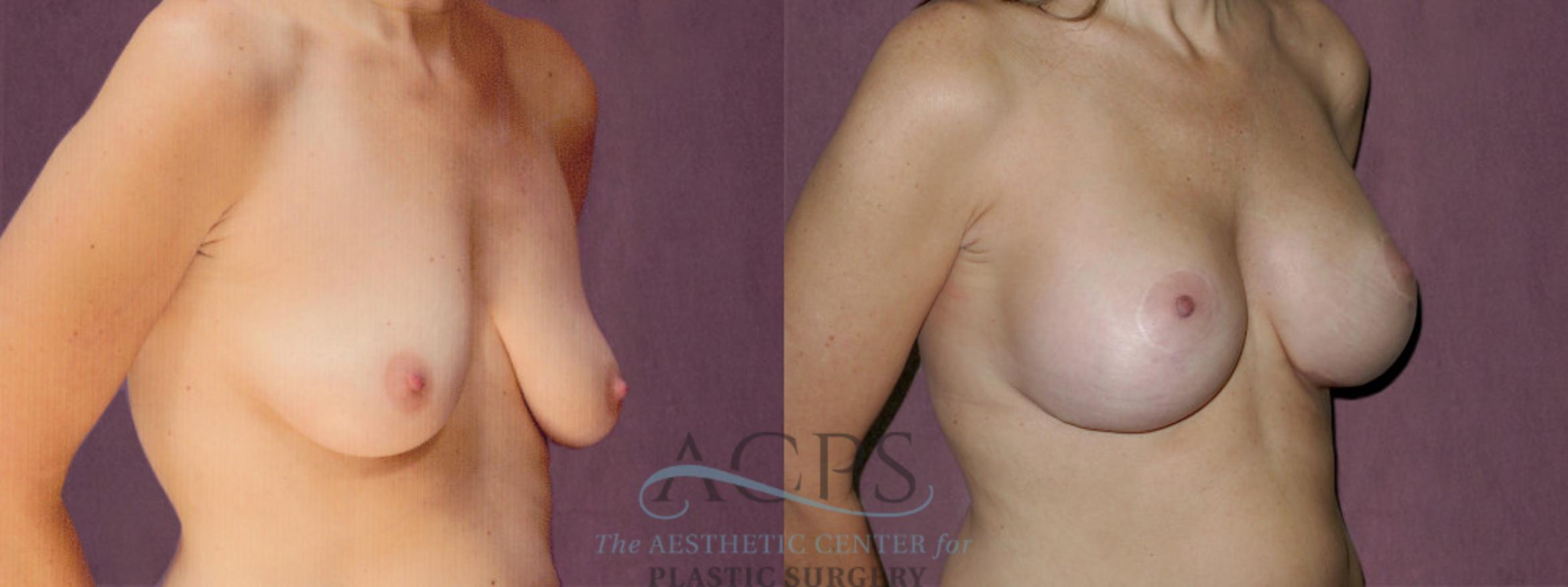 Before & After Breast Augmentation Case 934 Oblique Right View: View in Houston, TX