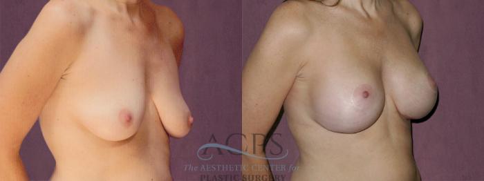 Before & After Breast Augmentation Case 934 Oblique Right View: View in Houston, TX