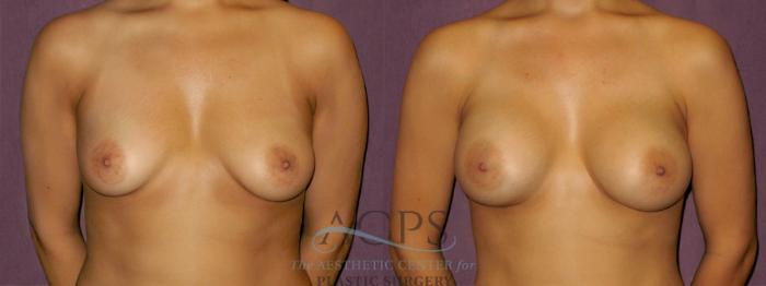 Before & After Breast Augmentation Case 935 Front View: View in Houston, TX