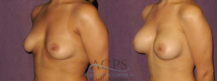 Before & After Breast Augmentation Case 935 Oblique Left View: View in Houston, TX