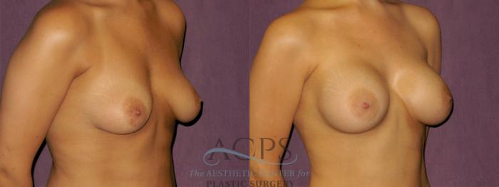 Before & After Breast Augmentation Case 935 Oblique Right View: View in Houston, TX