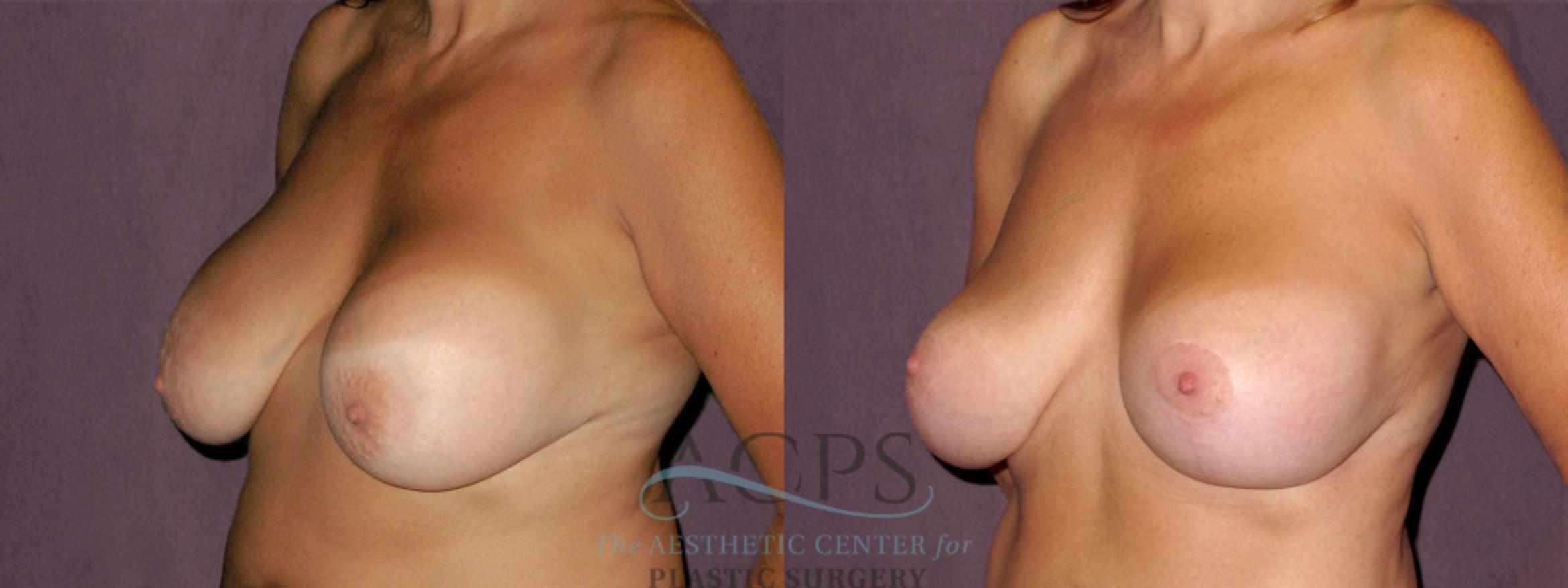 Before & After Breast Lift Case 936 Oblique Left View: View in Houston, TX