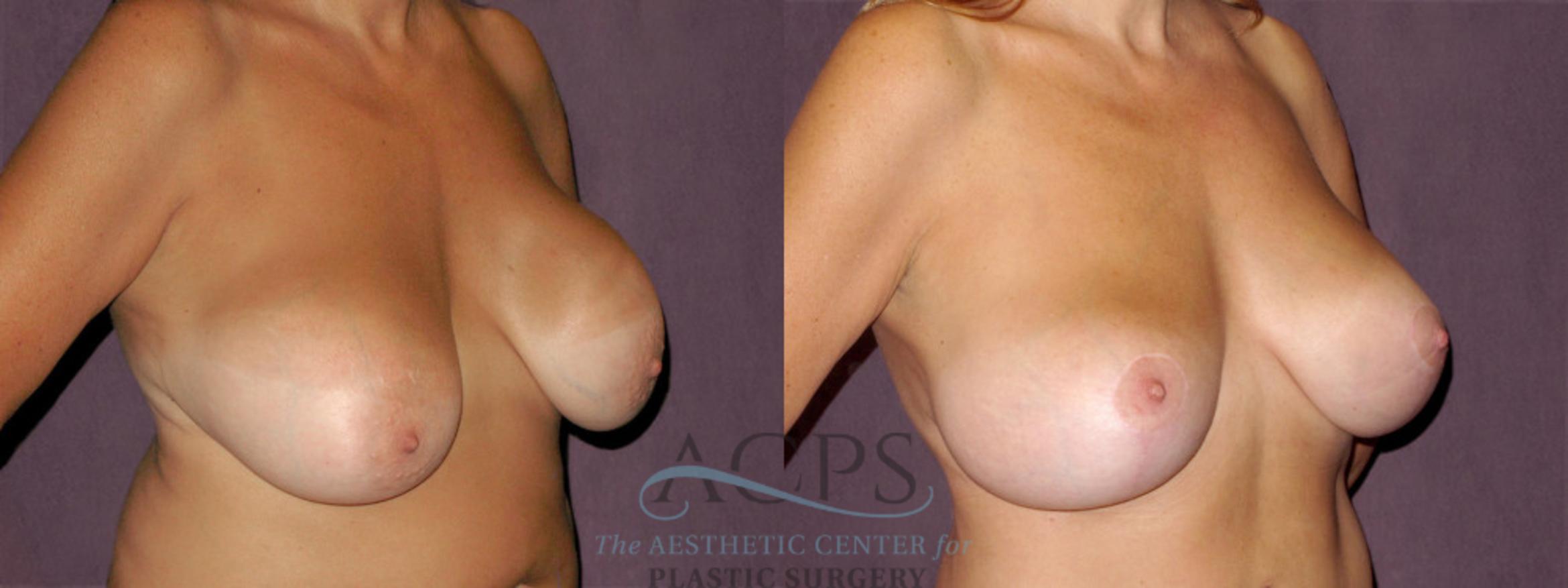 Before & After Breast Lift Case 936 Oblique Right View: View in Houston, TX
