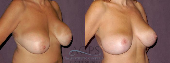 Before & After Breast Lift Case 936 Oblique Right View: View in Houston, TX