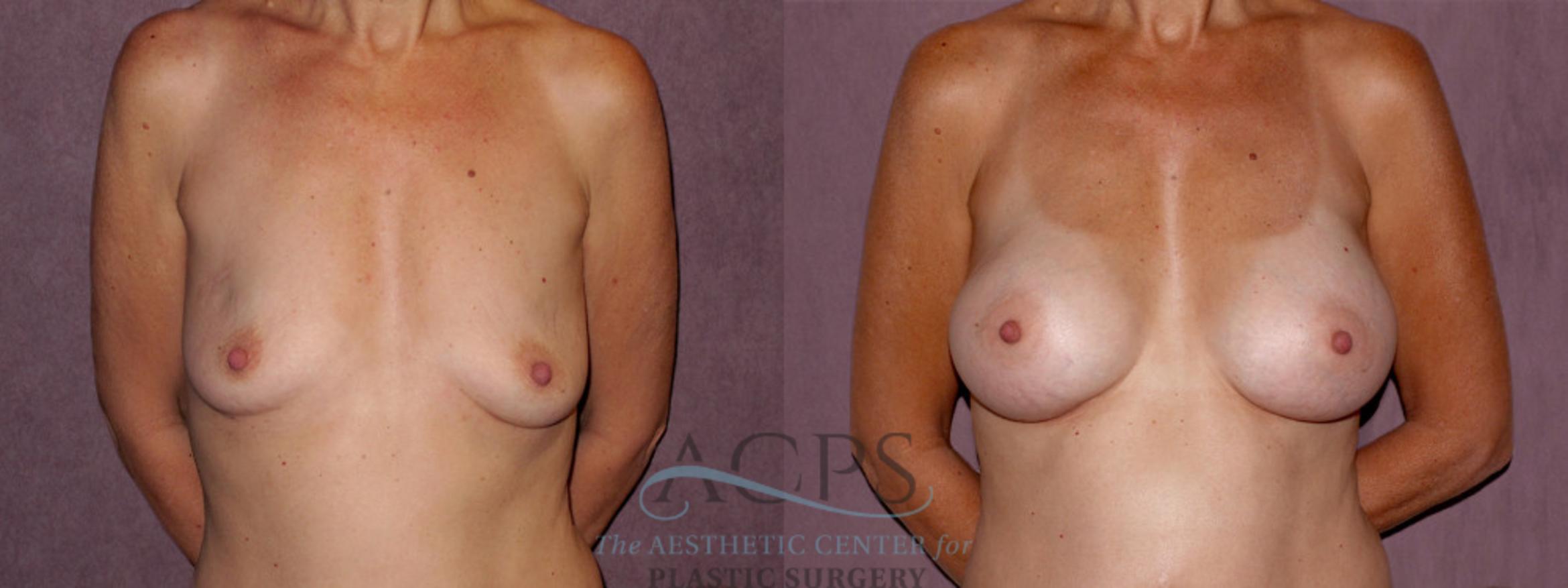 Before & After Breast Augmentation Case 937 Front View: View in Houston, TX