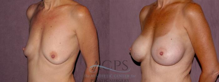 Before & After Breast Augmentation Case 937 Oblique Left View: View in Houston, TX