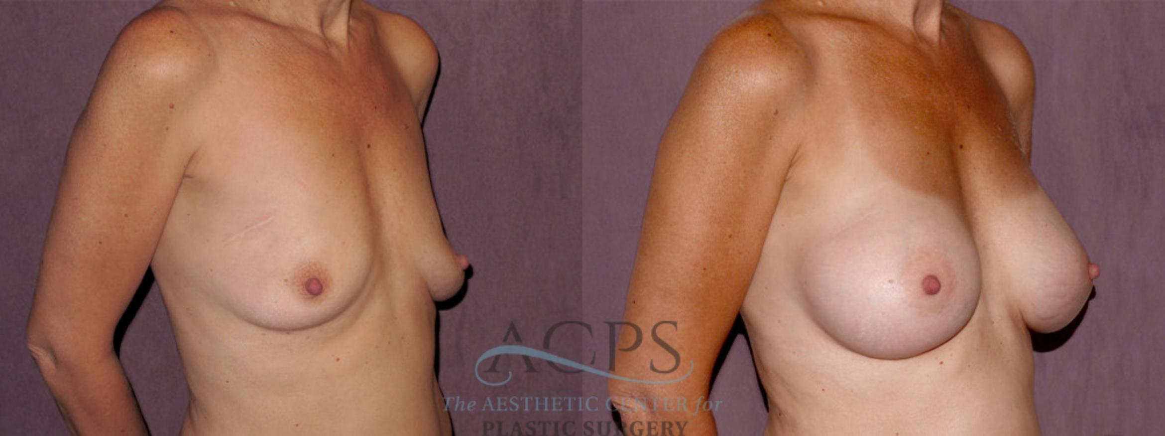 Before & After Breast Augmentation Case 937 Oblique Right View: View in Houston, TX