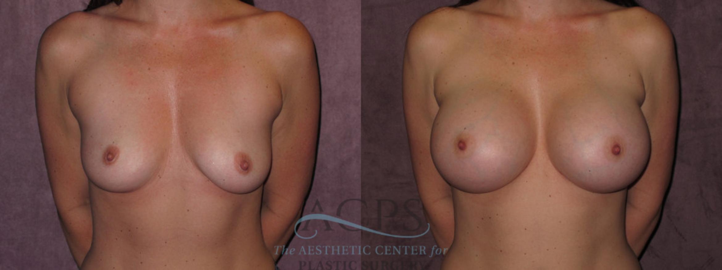 Before & After Breast Augmentation Case 938 Front View: View in Houston, TX