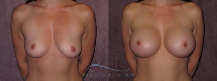Before & After Breast Augmentation Case 938 Front View: View in Houston, TX