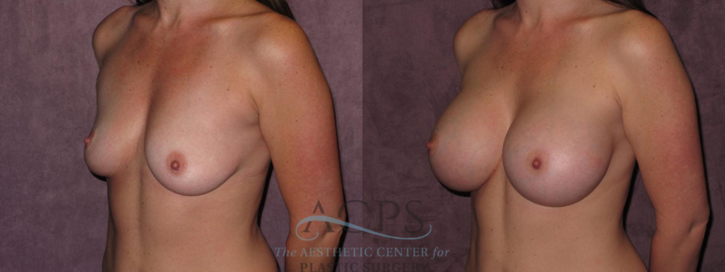 Before & After Breast Augmentation Case 938 Oblique Left View: View in Houston, TX