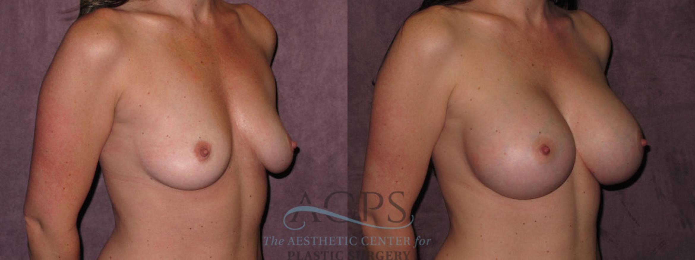 Before & After Breast Augmentation Case 938 Oblique Right View: View in Houston, TX