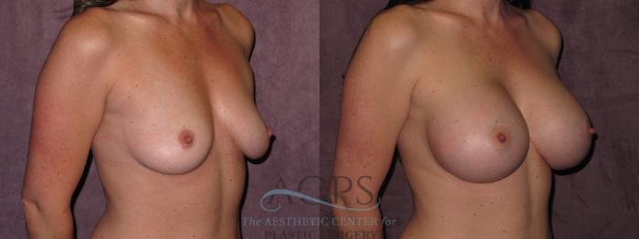 Before & After Breast Augmentation Case 938 Oblique Right View: View in Houston, TX