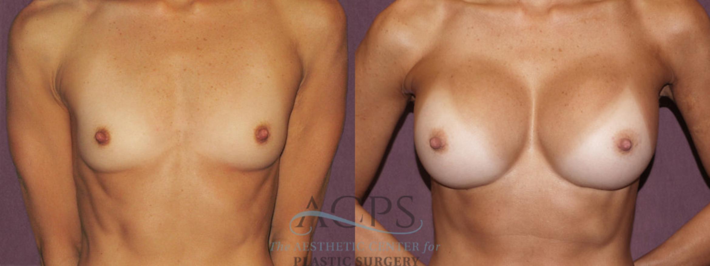 Before & After Breast Augmentation Case 939 Front View: View in Houston, TX