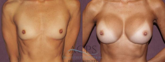 Before & After Breast Augmentation Case 939 Front View: View in Houston, TX