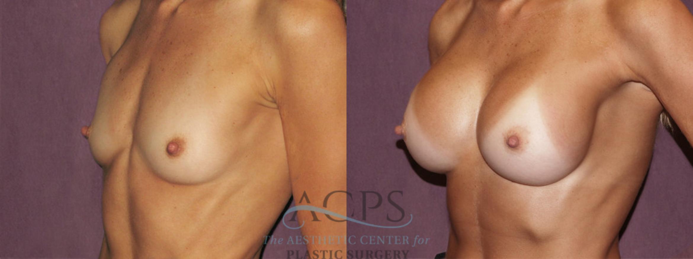 Before & After Breast Augmentation Case 939 Oblique Left View: View in Houston, TX