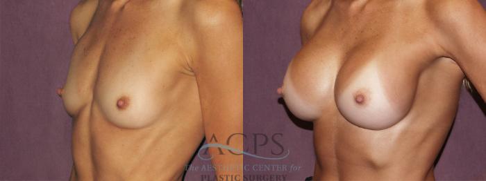 Before & After Breast Augmentation Case 939 Oblique Left View: View in Houston, TX
