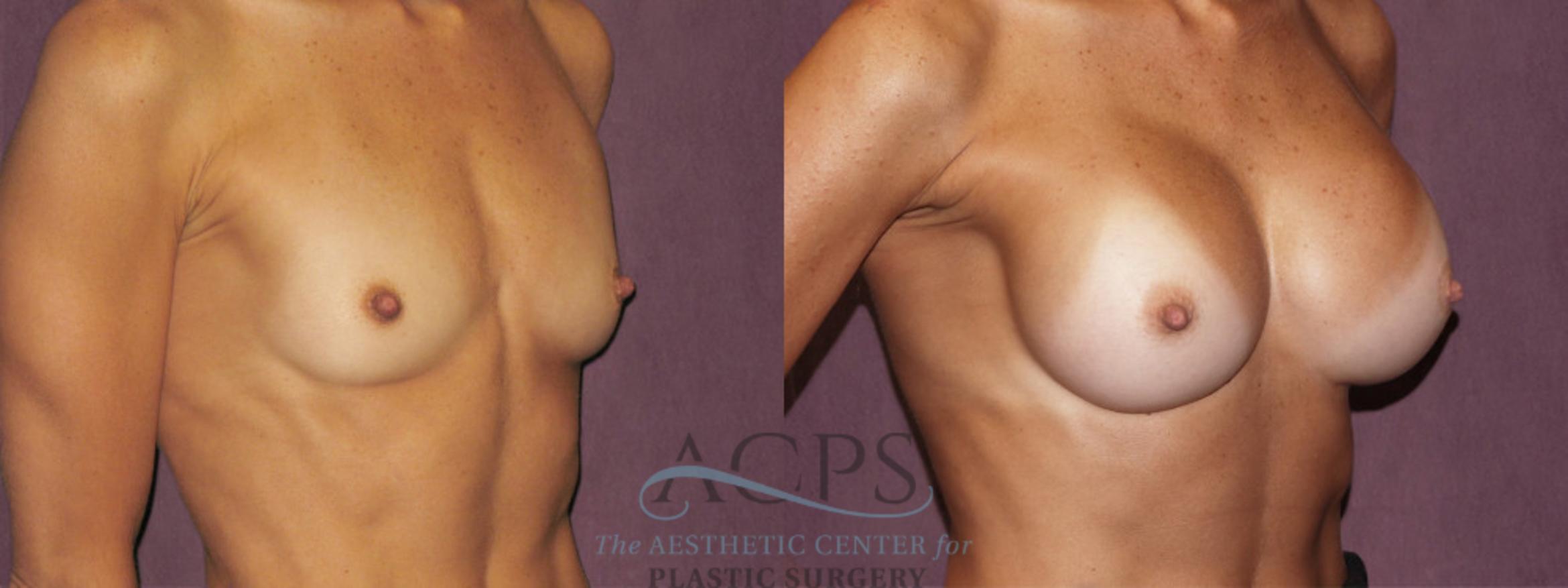 Before & After Breast Augmentation Case 939 Oblique Right View: View in Houston, TX