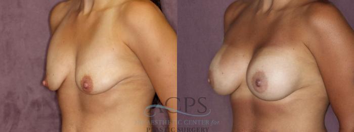 Before & After Breast Augmentation Case 940 Oblique Left View: View in Houston, TX