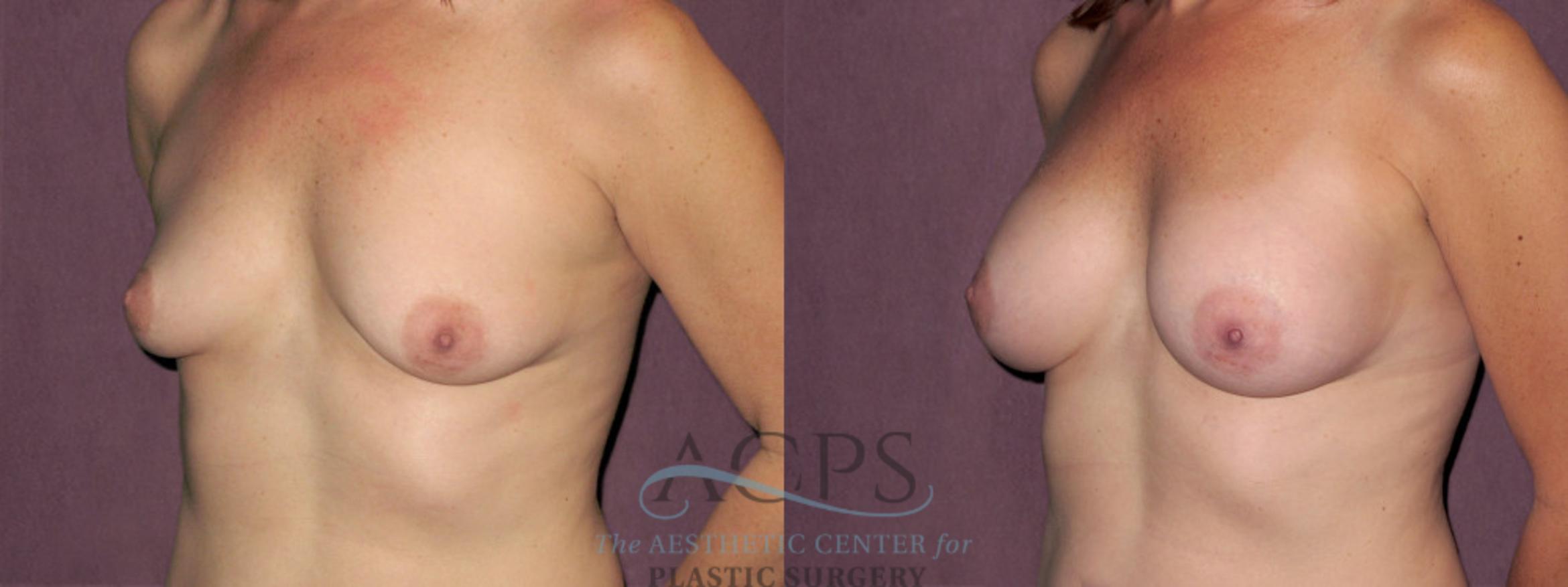 Before & After Breast Augmentation Case 941 Oblique Left View: View in Houston, TX