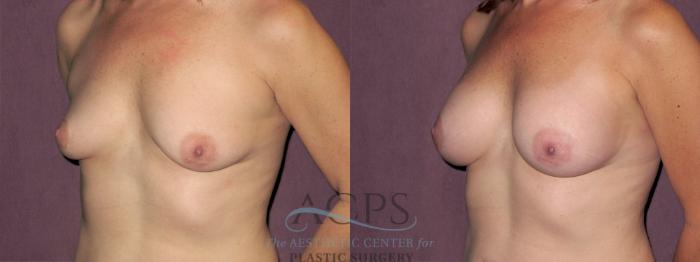 Before & After Breast Augmentation Case 941 Oblique Left View: View in Houston, TX