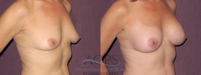 Before & After Breast Augmentation Case 941 Oblique Right View: View in Houston, TX