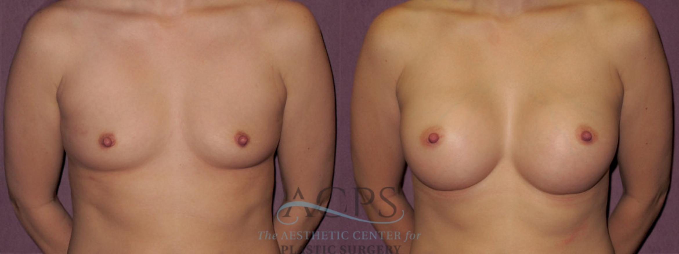Before & After Breast Augmentation Case 942 Front View: View in Houston, TX