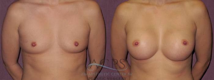 Before & After Breast Augmentation Case 942 Front View: View in Houston, TX