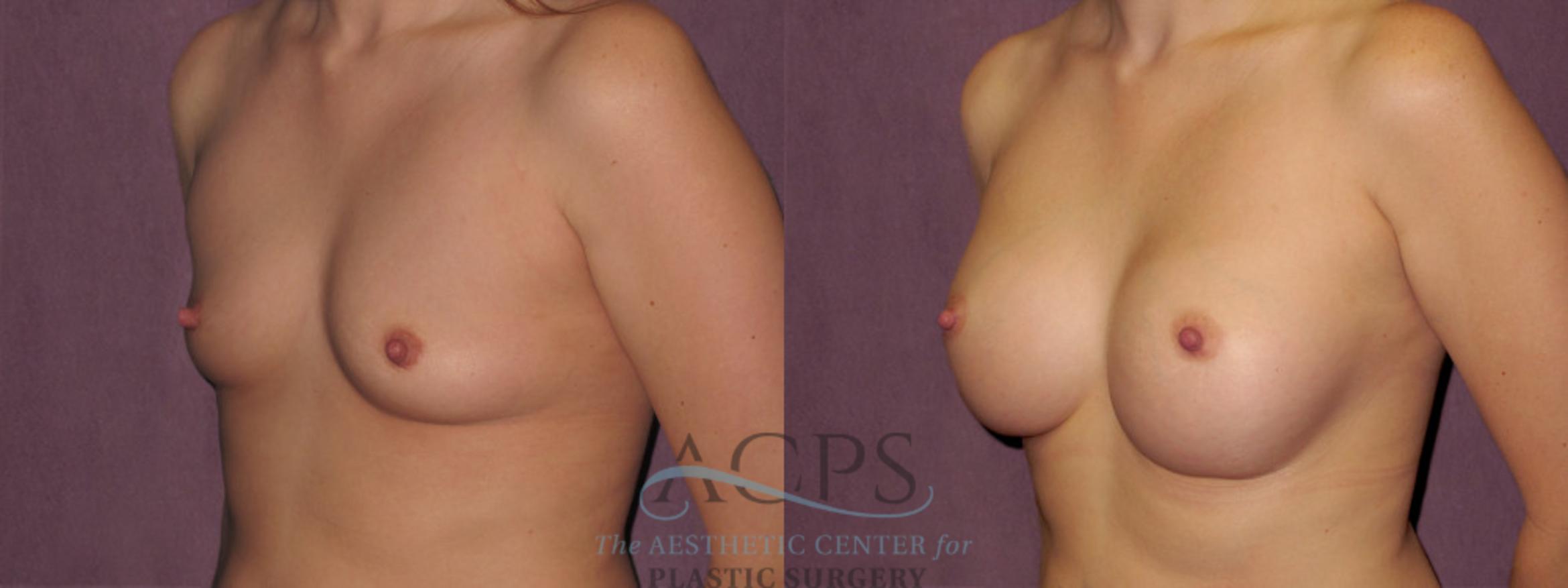 Before & After Breast Augmentation Case 942 Oblique Left View: View in Houston, TX