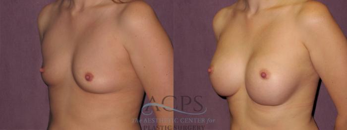 Before & After Breast Augmentation Case 942 Oblique Left View: View in Houston, TX