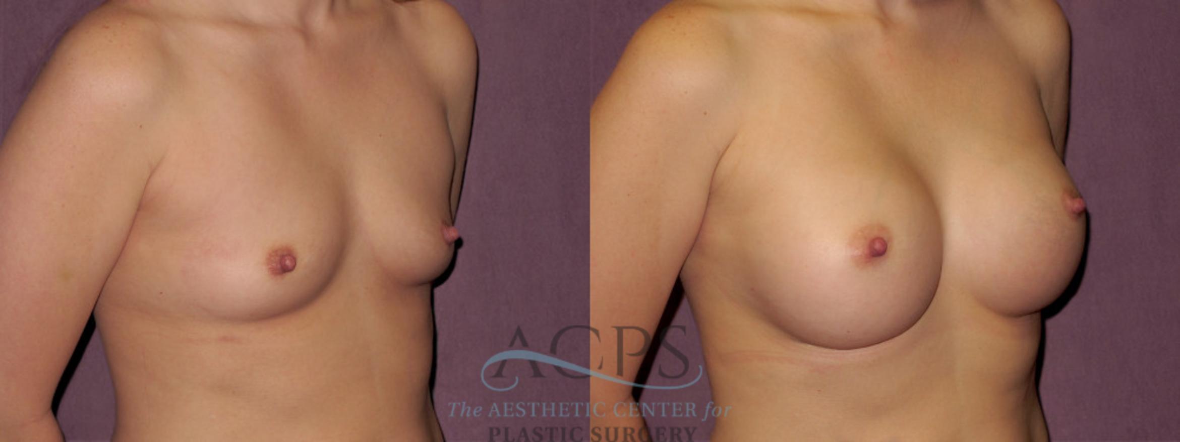 Before & After Breast Augmentation Case 942 Oblique Right View: View in Houston, TX