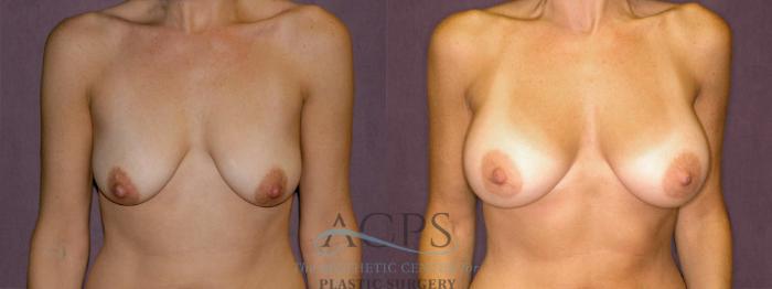 Before & After Breast Augmentation Case 943 Front View: View in Houston, TX