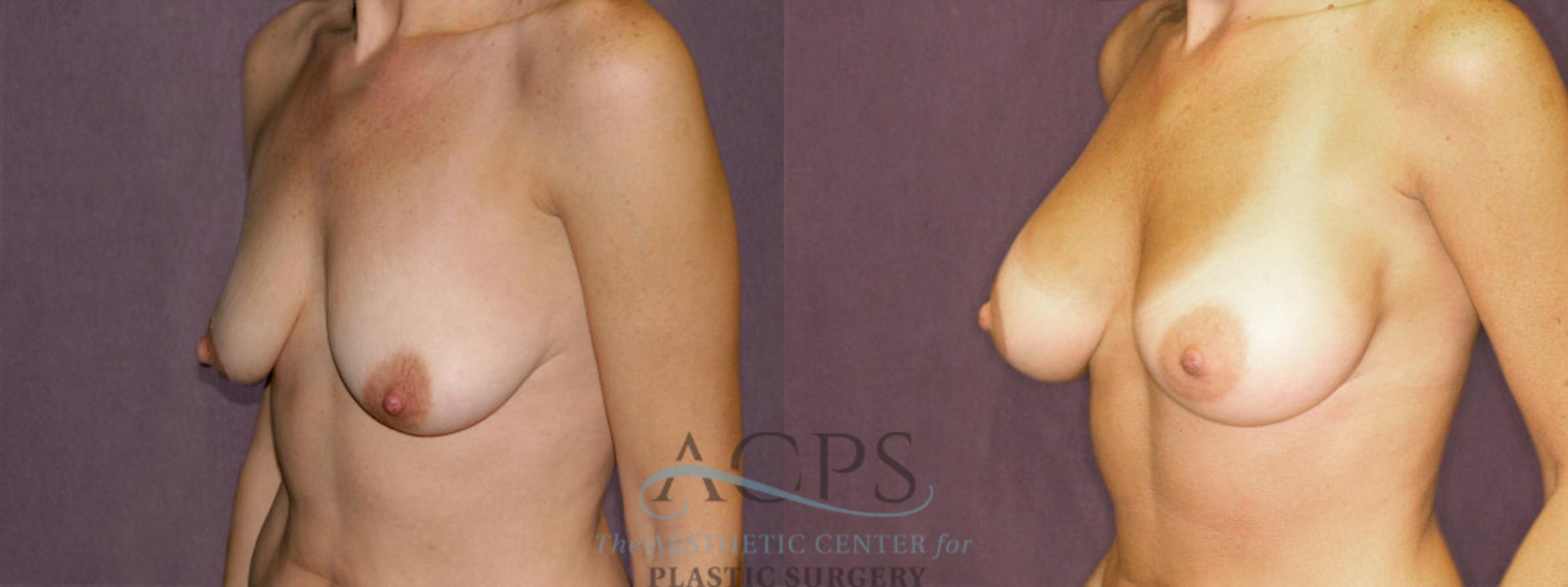 Before & After Breast Augmentation Case 943 Oblique Left View: View in Houston, TX