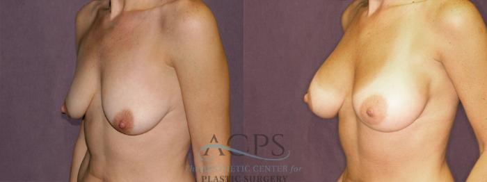 Before & After Breast Augmentation Case 943 Oblique Left View: View in Houston, TX