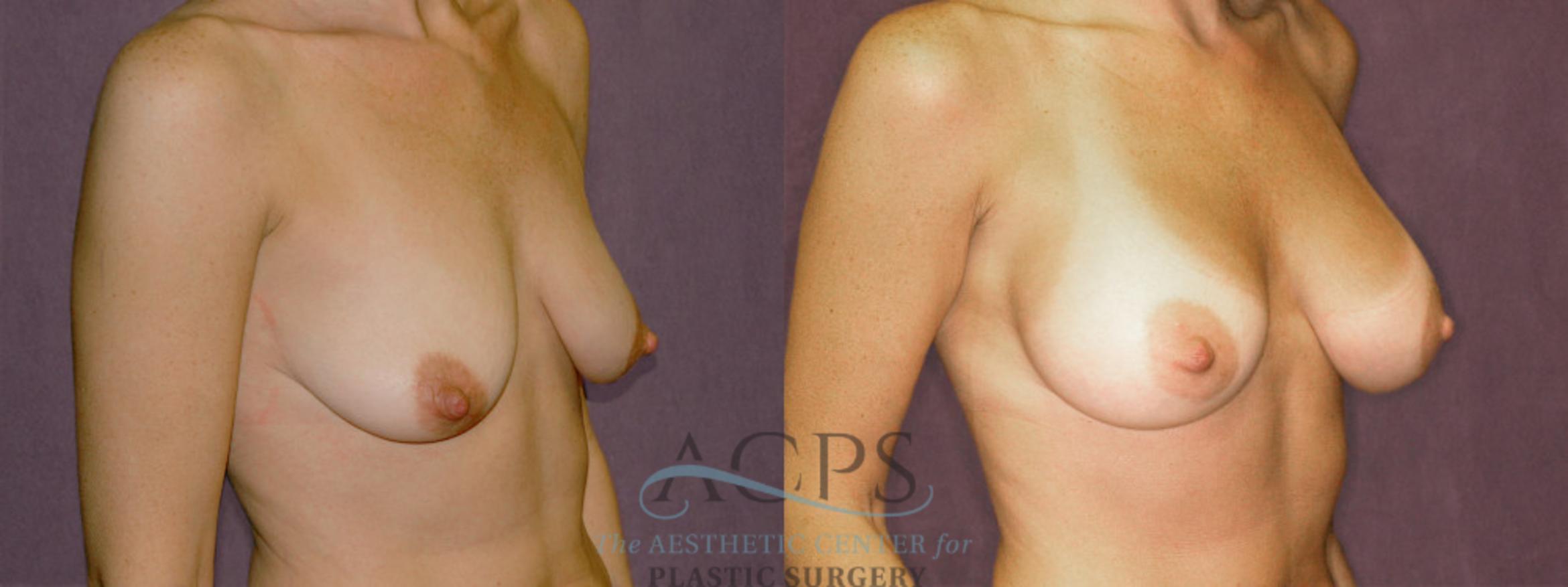 Before & After Breast Augmentation Case 943 Oblique Right View: View in Houston, TX