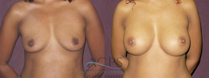 Before & After Breast Augmentation Case 944 Front View: View in Houston, TX