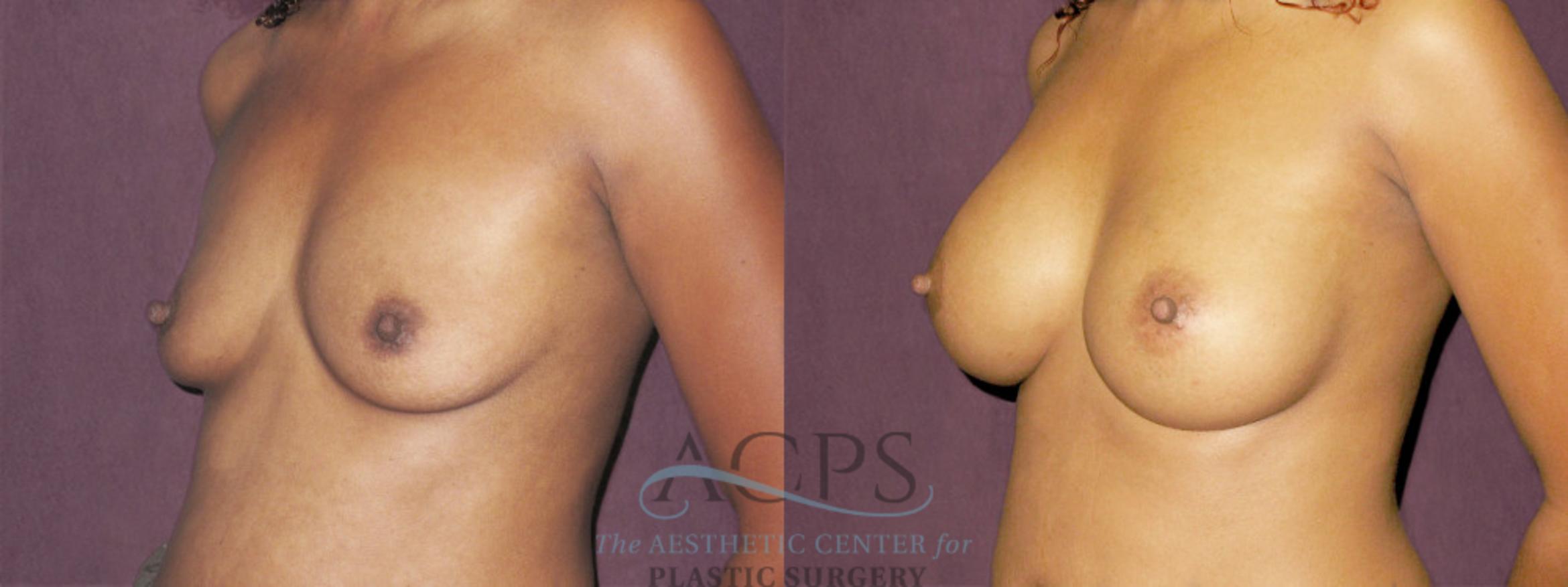 Before & After Breast Augmentation Case 944 Oblique Left View: View in Houston, TX