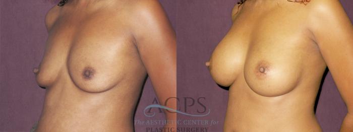 Before & After Breast Augmentation Case 944 Oblique Left View: View in Houston, TX
