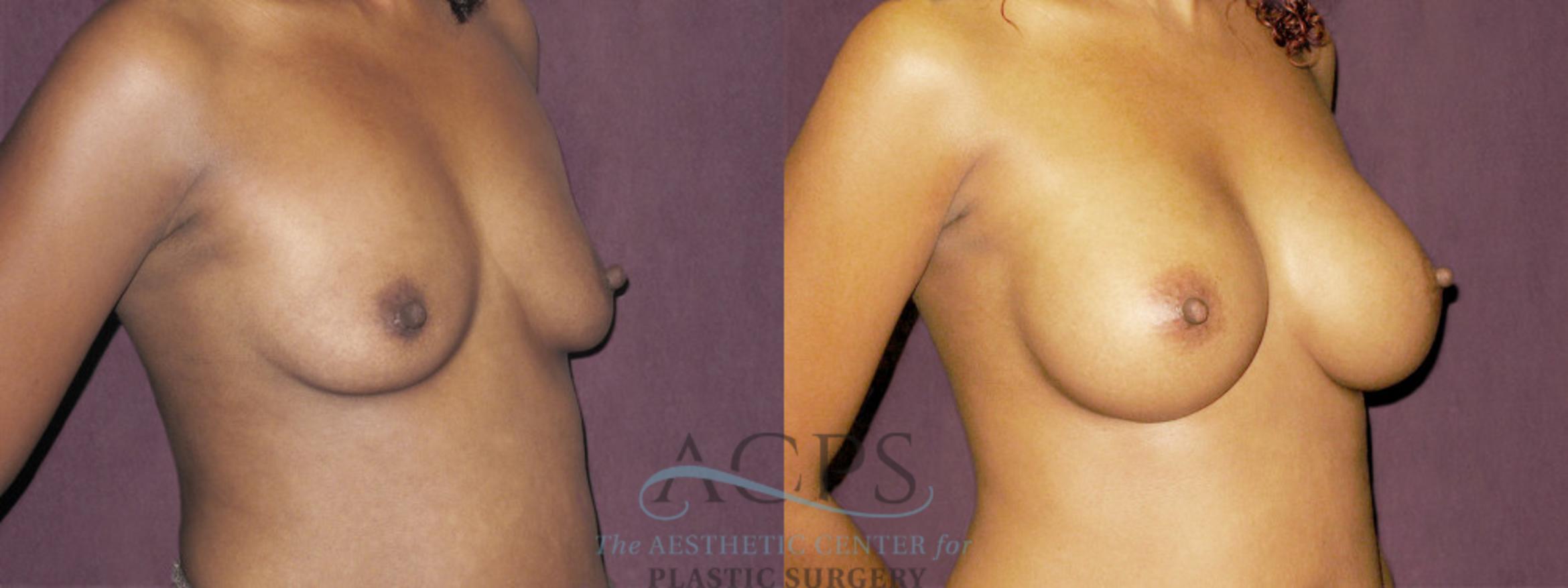 Before & After Breast Augmentation Case 944 Oblique Right View: View in Houston, TX