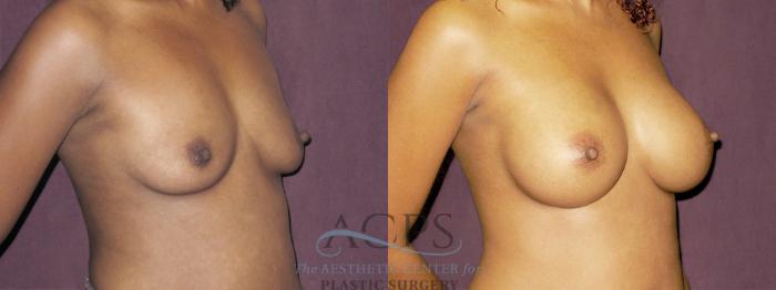 Before & After Breast Augmentation Case 944 Oblique Right View: View in Houston, TX