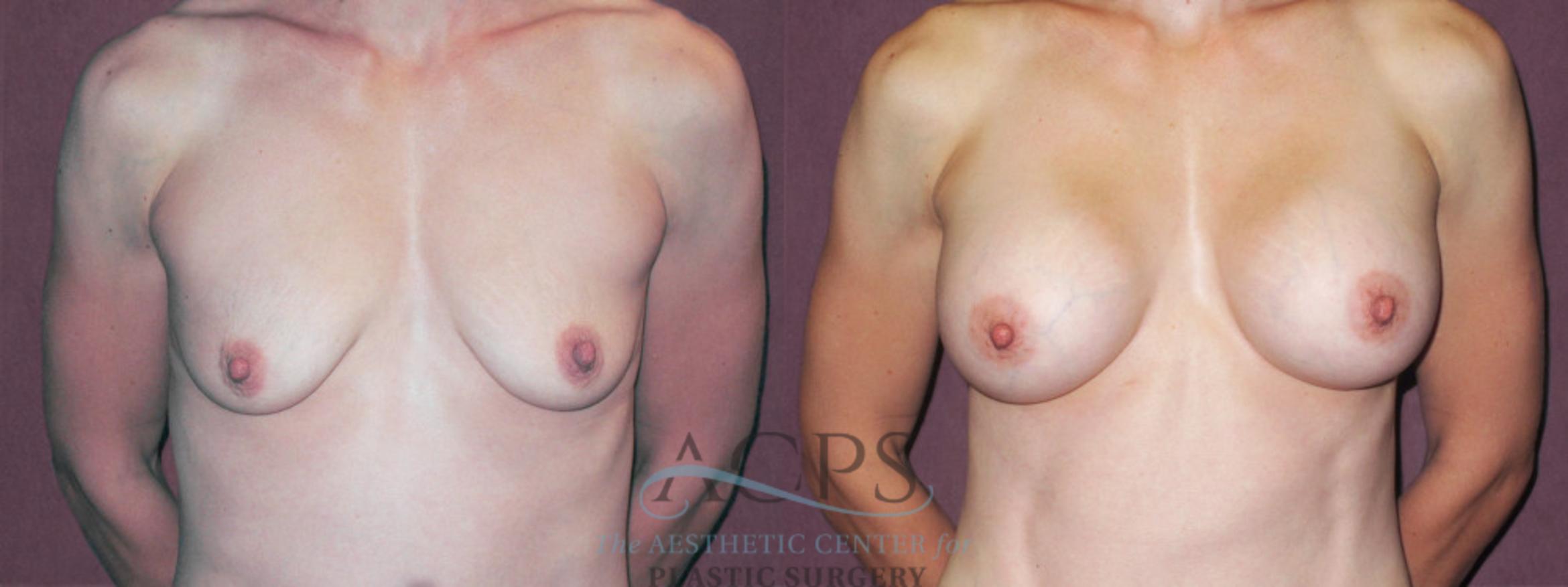 Before & After Breast Augmentation Case 945 Front View: View in Houston, TX