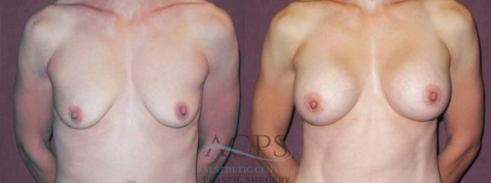 Before & After Breast Augmentation Case 945 Front View: View in Houston, TX
