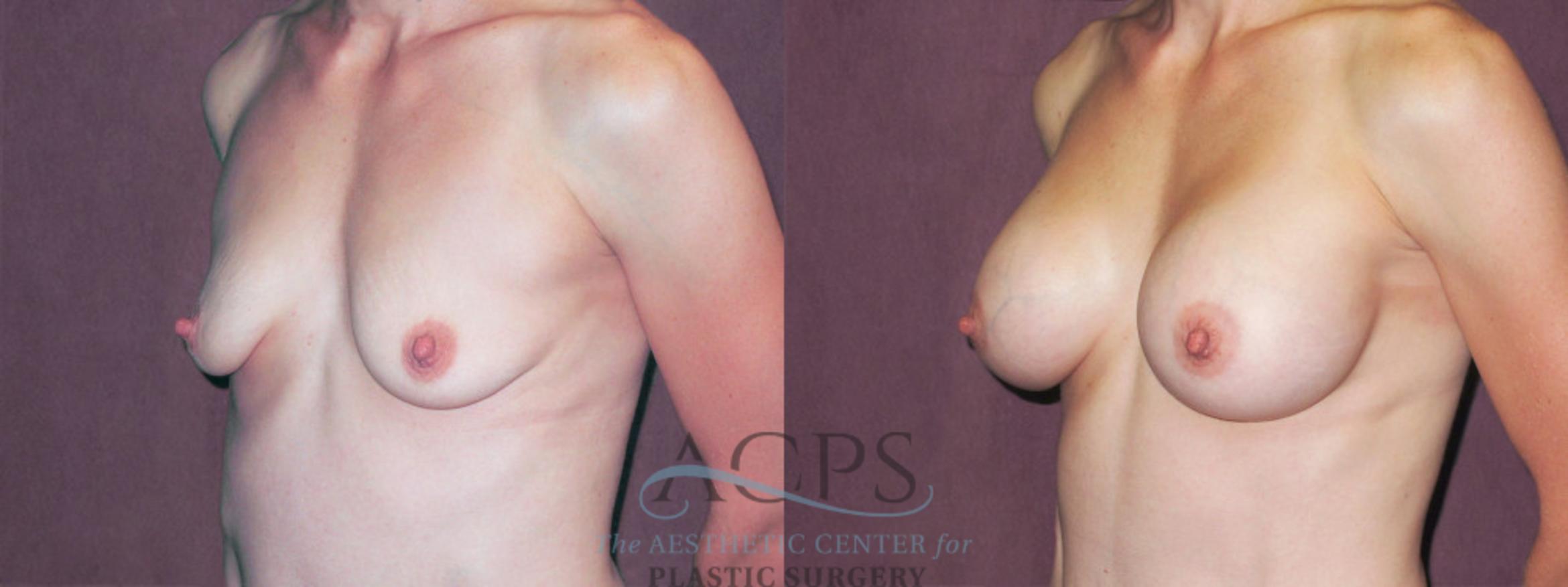 Before & After Breast Augmentation Case 945 Oblique Left View: View in Houston, TX