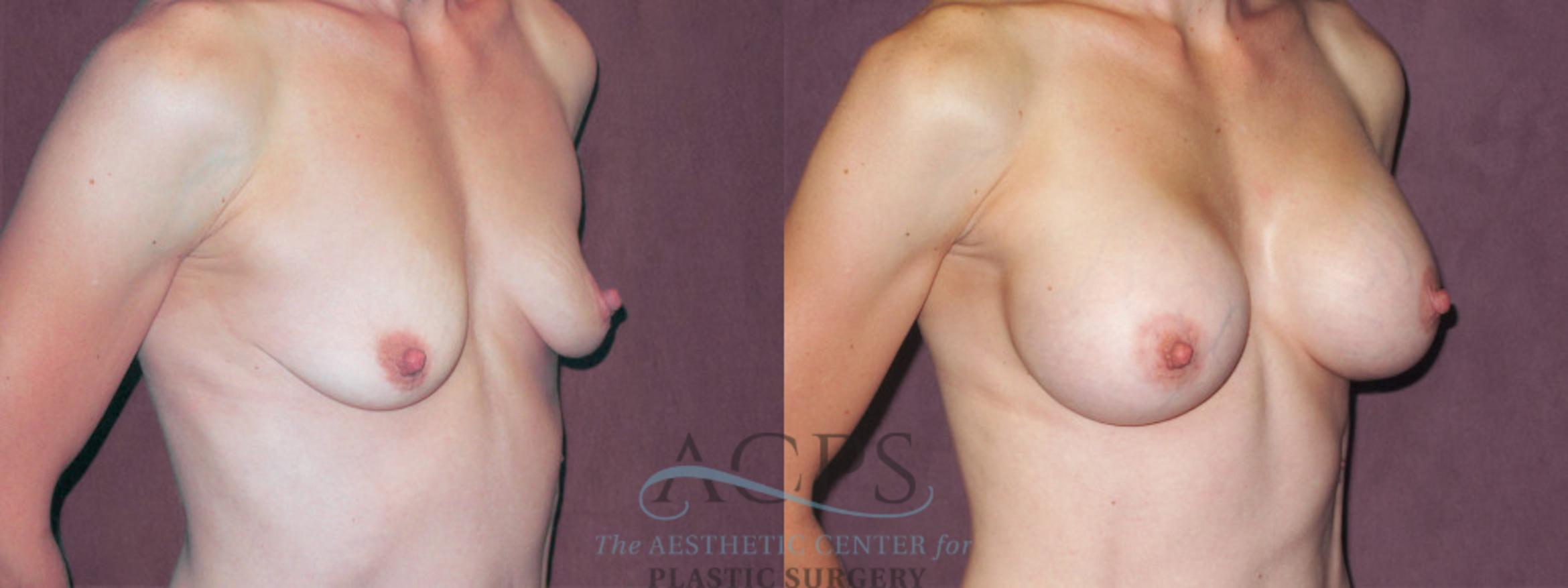 Before & After Breast Augmentation Case 945 Oblique Right View: View in Houston, TX