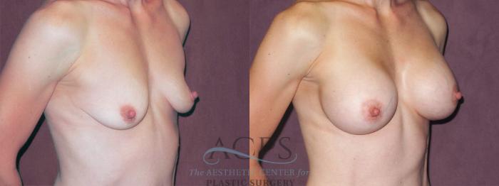 Before & After Breast Augmentation Case 945 Oblique Right View: View in Houston, TX