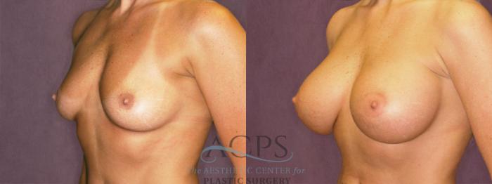 Before & After Breast Augmentation Case 946 Oblique Left View: View in Houston, TX